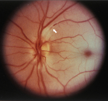 Central Retinal Artery Obstruction (CRAO)